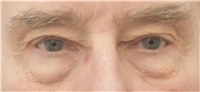 Eyelid Surgery Before Photo by Keshav Magge, MD; Bethesda, MD - Case 36856
