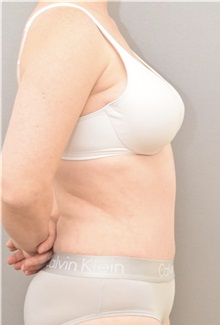 Tummy Tuck After Photo by Keshav Magge, MD; Bethesda, MD - Case 36857