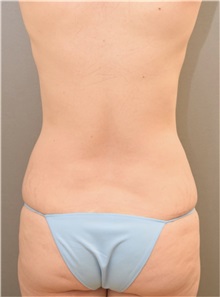 Liposuction Before Photo by Keshav Magge, MD; Bethesda, MD - Case 36858