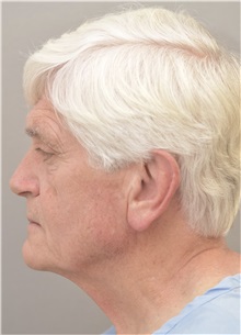 Facelift Before Photo by Keshav Magge, MD; Bethesda, MD - Case 37002