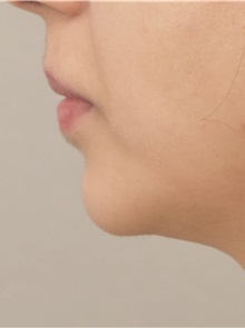 Chin Augmentation After Photo by Keshav Magge, MD; Bethesda, MD - Case 37012
