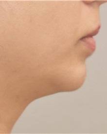 Chin Augmentation After Photo by Keshav Magge, MD; Bethesda, MD - Case 37012