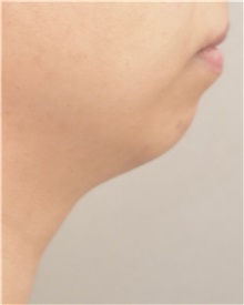Chin Augmentation Before Photo by Keshav Magge, MD; Bethesda, MD - Case 37012