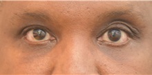 Eyelid Surgery After Photo by Keshav Magge, MD; Bethesda, MD - Case 37013
