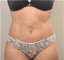 Liposuction After Photo by Keshav Magge, MD; Bethesda, MD - Case 37015