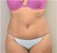 Liposuction Before Photo by Keshav Magge, MD; Bethesda, MD - Case 37015