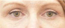Eyelid Surgery After Photo by Keshav Magge, MD; Bethesda, MD - Case 37017
