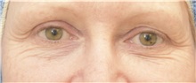 Eyelid Surgery Before Photo by Keshav Magge, MD; Bethesda, MD - Case 37017