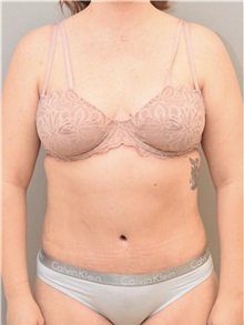 Tummy Tuck After Photo by Keshav Magge, MD; Bethesda, MD - Case 37018