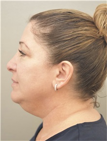 Facelift Before Photo by Keshav Magge, MD; Bethesda, MD - Case 37019