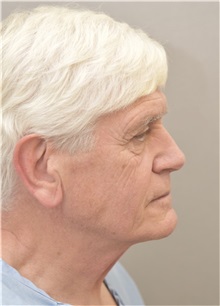 Neck Lift Before Photo by Keshav Magge, MD; Bethesda, MD - Case 37035