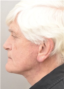 Neck Lift After Photo by Keshav Magge, MD; Bethesda, MD - Case 37035
