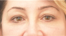 Eyelid Surgery After Photo by Keshav Magge, MD; Bethesda, MD - Case 37036