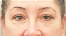 Eyelid Surgery Before Photo by Keshav Magge, MD; Bethesda, MD - Case 37036