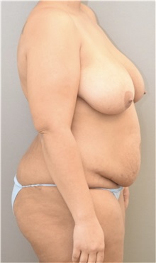 Tummy Tuck Before Photo by Keshav Magge, MD; Bethesda, MD - Case 37039