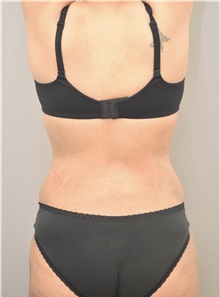 Liposuction After Photo by Keshav Magge, MD; Bethesda, MD - Case 37040