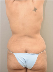 Liposuction Before Photo by Keshav Magge, MD; Bethesda, MD - Case 37040