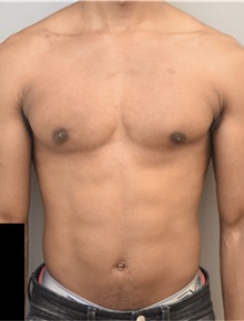 Male Breast Reduction After Photo by Keshav Magge, MD; Bethesda, MD - Case 37042