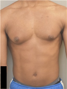 Male Breast Reduction Before Photo by Keshav Magge, MD; Bethesda, MD - Case 37042