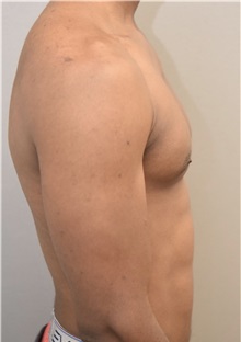 Male Breast Reduction After Photo by Keshav Magge, MD; Bethesda, MD - Case 37042