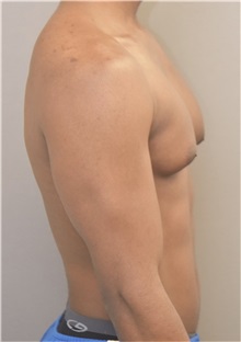 Male Breast Reduction Before Photo by Keshav Magge, MD; Bethesda, MD - Case 37042