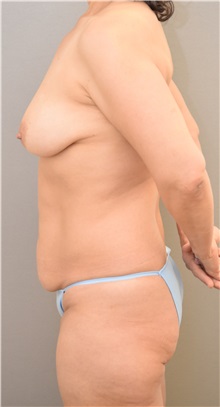 Breast Lift Before Photo by Keshav Magge, MD; Bethesda, MD - Case 37044