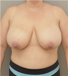 Breast Reduction Before Photo by Keshav Magge, MD; Bethesda, MD - Case 37046