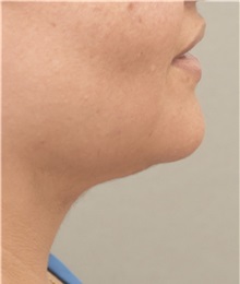 Liposuction After Photo by Keshav Magge, MD; Bethesda, MD - Case 37072