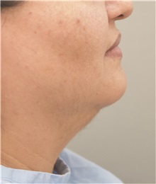 Liposuction Before Photo by Keshav Magge, MD; Bethesda, MD - Case 37072