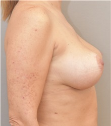 Breast Lift After Photo by Keshav Magge, MD; Bethesda, MD - Case 37073