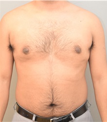 Male Breast Reduction After Photo by Keshav Magge, MD; Bethesda, MD - Case 37076