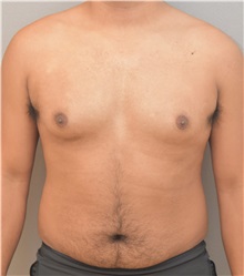 Male Breast Reduction Before Photo by Keshav Magge, MD; Bethesda, MD - Case 37076