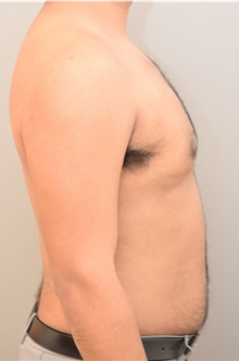 Male Breast Reduction After Photo by Keshav Magge, MD; Bethesda, MD - Case 37076