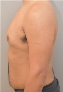 Male Breast Reduction Before Photo by Keshav Magge, MD; Bethesda, MD - Case 37076