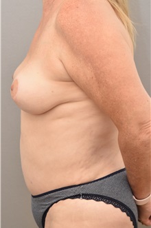 Breast Lift After Photo by Keshav Magge, MD; Bethesda, MD - Case 37077