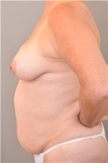 Breast Lift Before Photo by Keshav Magge, MD; Bethesda, MD - Case 37077