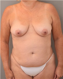 Tummy Tuck Before Photo by Keshav Magge, MD; Bethesda, MD - Case 37078