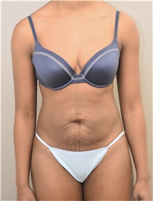 Tummy Tuck Before Photo by Keshav Magge, MD; Bethesda, MD - Case 37082
