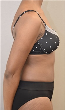 Tummy Tuck After Photo by Keshav Magge, MD; Bethesda, MD - Case 37082