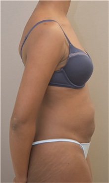 Tummy Tuck Before Photo by Keshav Magge, MD; Bethesda, MD - Case 37082