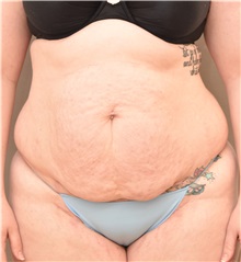 Tummy Tuck Before Photo by Keshav Magge, MD; Bethesda, MD - Case 37188