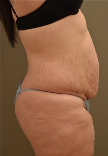 Tummy Tuck Before Photo by Keshav Magge, MD; Bethesda, MD - Case 37188