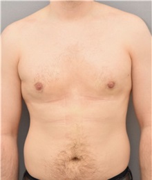 Male Breast Reduction After Photo by Keshav Magge, MD; Bethesda, MD - Case 37189