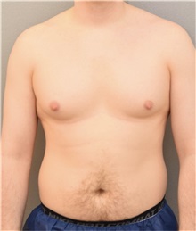 Male Breast Reduction Before Photo by Keshav Magge, MD; Bethesda, MD - Case 37189