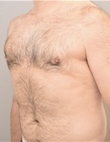 Male Breast Reduction After Photo by Keshav Magge, MD; Bethesda, MD - Case 37190