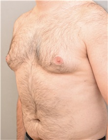 Male Breast Reduction Before Photo by Keshav Magge, MD; Bethesda, MD - Case 37190