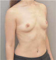 Breast Augmentation Before Photo by Keshav Magge, MD; Bethesda, MD - Case 37217