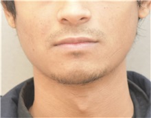 Chin Augmentation Before Photo by Keshav Magge, MD; Bethesda, MD - Case 37519