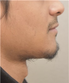 Chin Augmentation After Photo by Keshav Magge, MD; Bethesda, MD - Case 37519