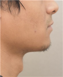 Chin Augmentation Before Photo by Keshav Magge, MD; Bethesda, MD - Case 37519